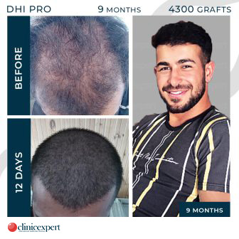 DHI Pro - Hair Transplant - 9 Months - 4300Grafts
