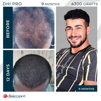 DHI Hair Transplant | ClinicExpert DHI Hair Transplant | ClinicExpert