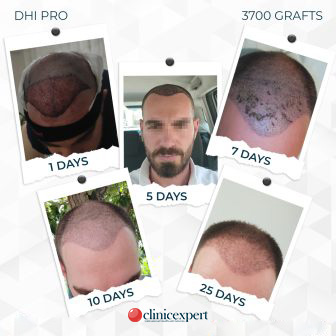 DHI Pro - Hair Transplant - 25 Days - 3700Grafts