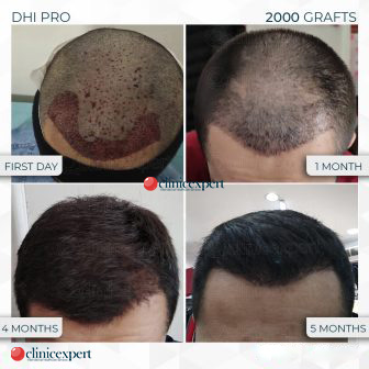 Best Hair Transplant Result in Indore  4 Months 11 Days 