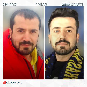 DHI Pro - Hair Transplant - 1 Year - 2600 Grafts