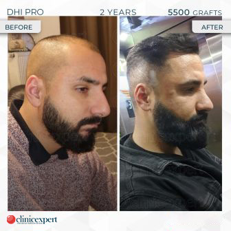 DHI Pro - Hair Transplant - 2 Years - 5500 Grafts