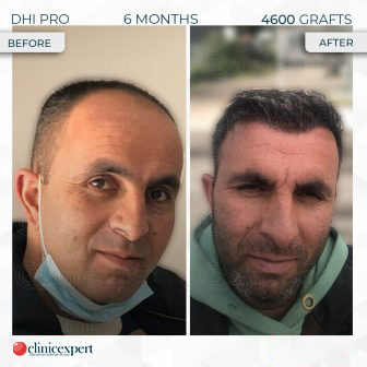 DHI Pro - Hair Transplant - 6 Months - 4600 Grafts