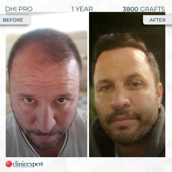 DHI Pro - Hair Transplant - 1 Years - 3800 Grafts