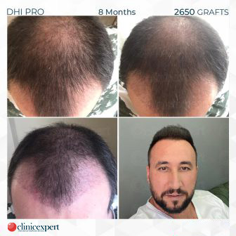 DHI Pro - Hair Transplant - 8 Months - 2650 Grafts