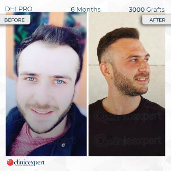 DHI Pro - Hair Transplant - 6 Months - 3000 Grafts