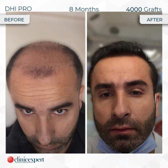 DHI Pro - Hair Transplant - 8 Months - 4000 Grafts