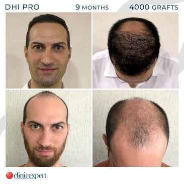 DHI Pro - Hair Transplant - 9 Months - 4000Grafts