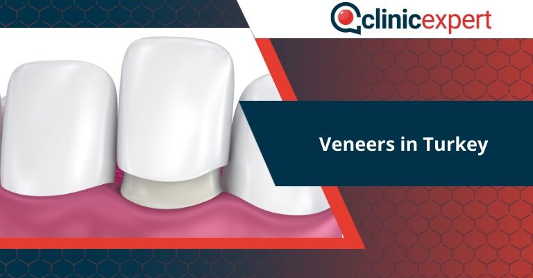 Veneers in Turkey