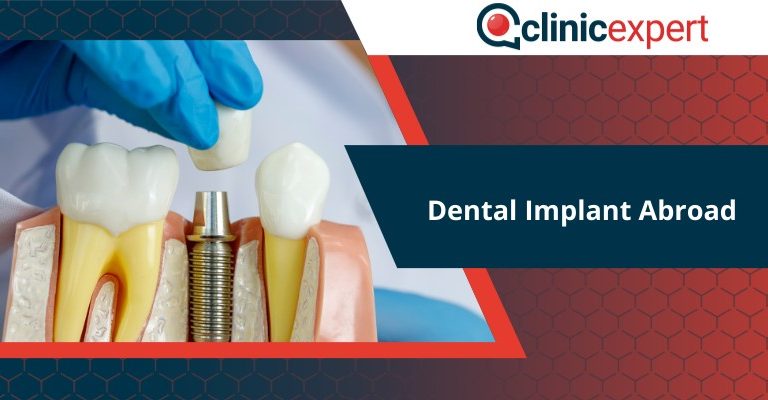 Dental Implant Abroad