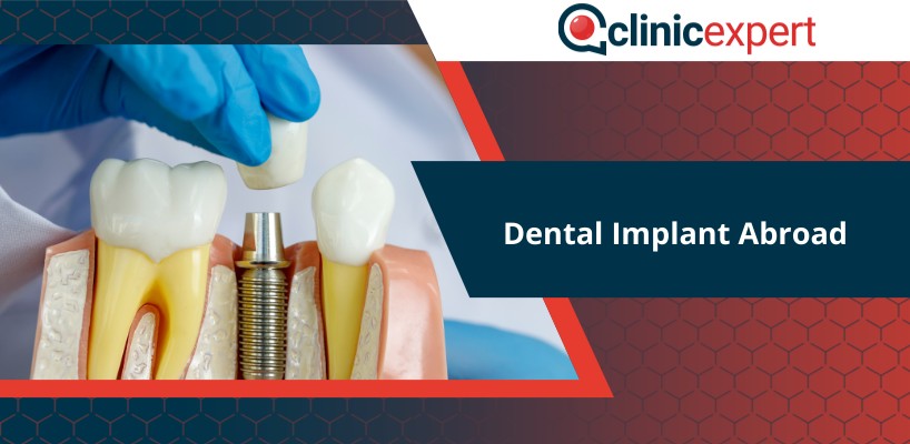 Dental Implant Abroad