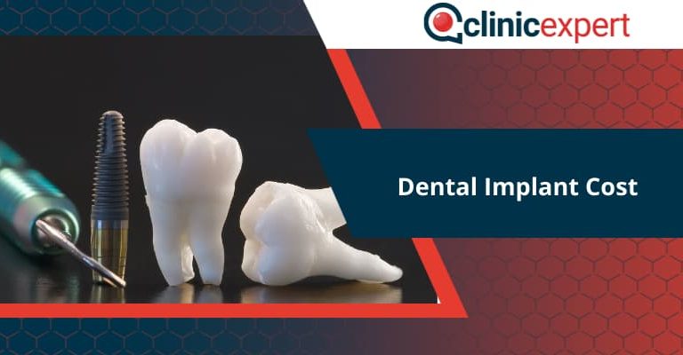 Dental Implant Cost