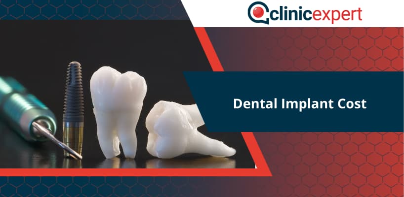 Dental Implant Cost