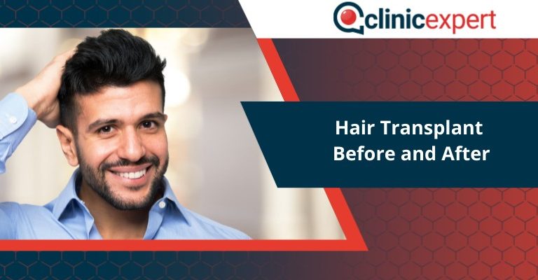 Hair Transplant Before and After