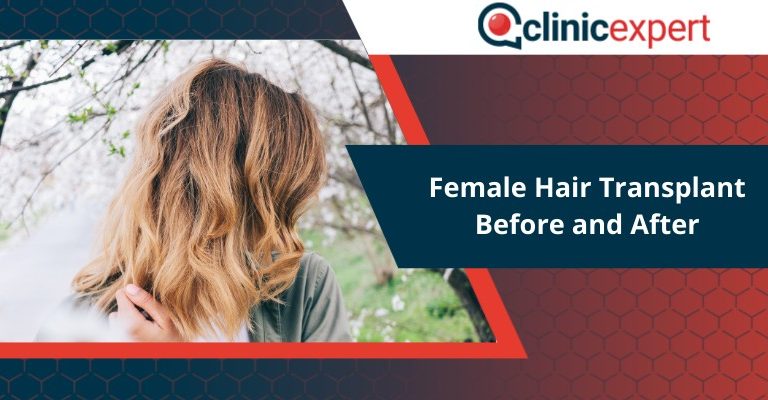 Female Hair Transplant Before and After