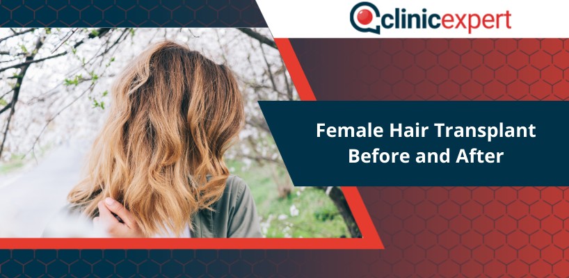 Female Hair Transplant Before and After