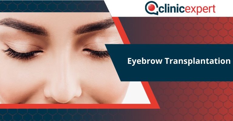 Eyebrow Transplantation