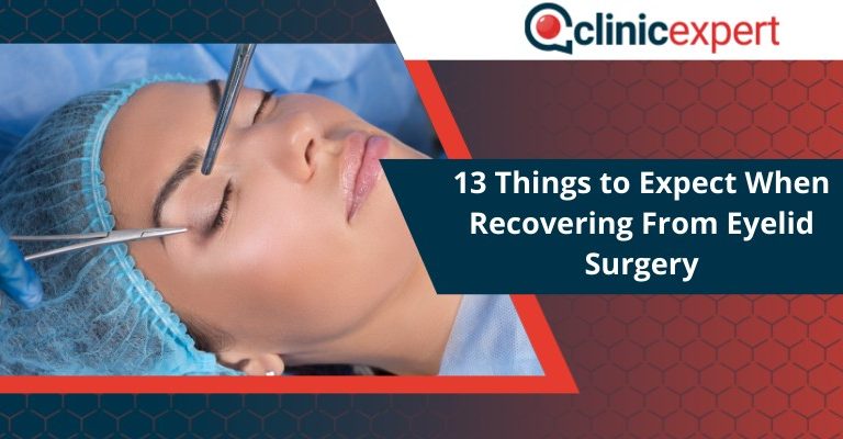 13 Things to Expect When Recovering From Eyelid Surgery