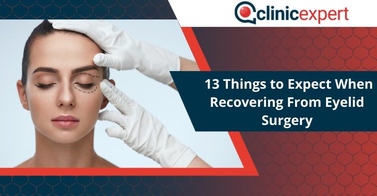 13 Things to Expect When Recovering From Blepharoplasty