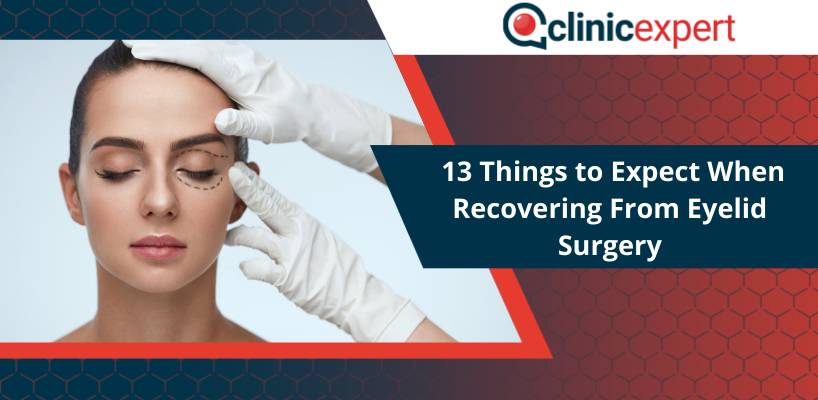 13 Things to Expect When Recovering From Blepharoplasty