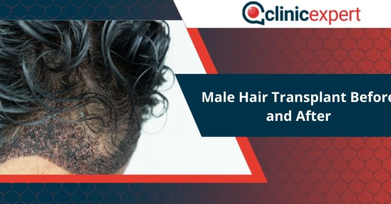 Male Hair Transplant Before and After
