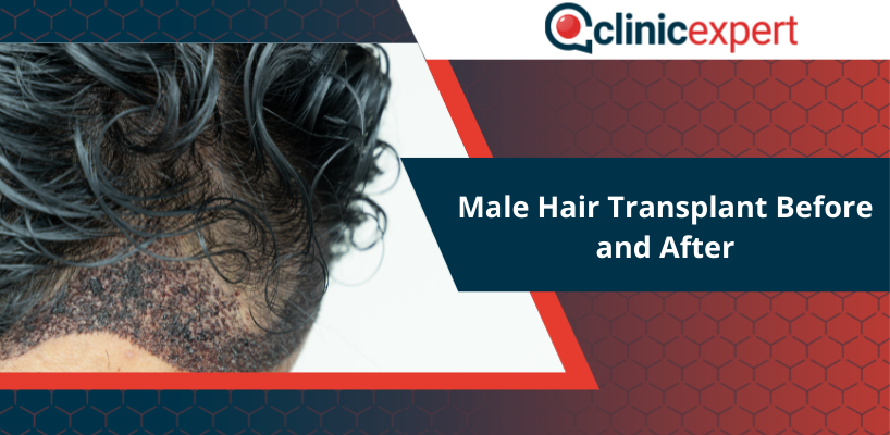 Male Hair Transplant Before and After