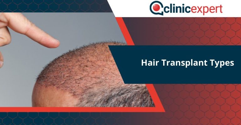 Hair Transplant Types
