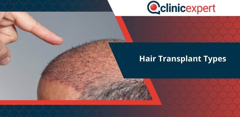 Hair Transplant Types