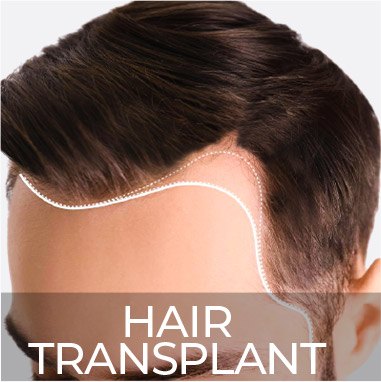 Hair Transplant in Clinicexpert