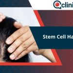 Stem Cell Hair Transplant