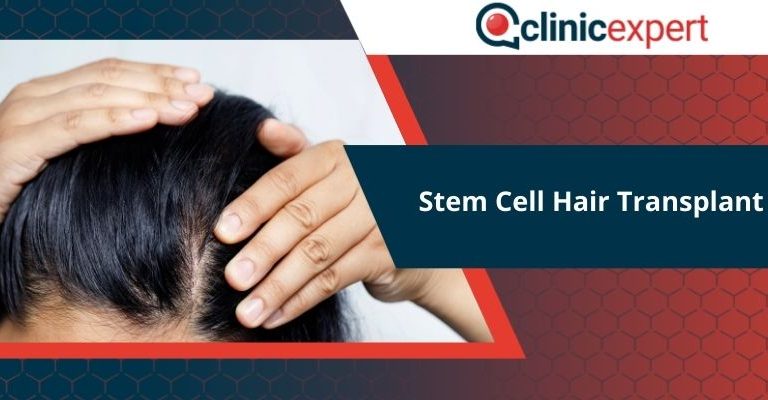 Stem Cell Hair Transplant