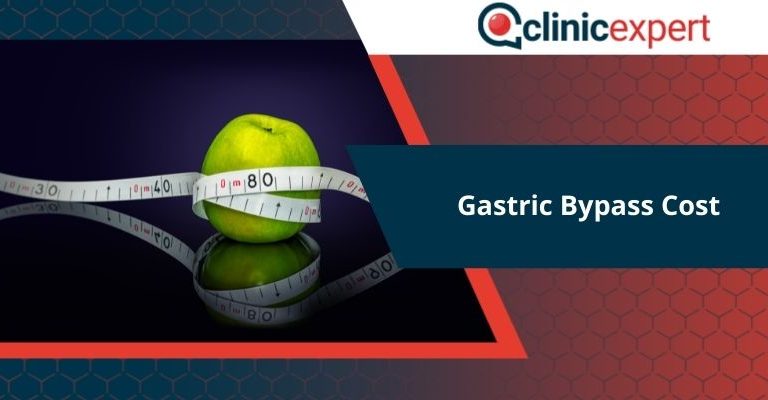 Gastric Bypass Cost
