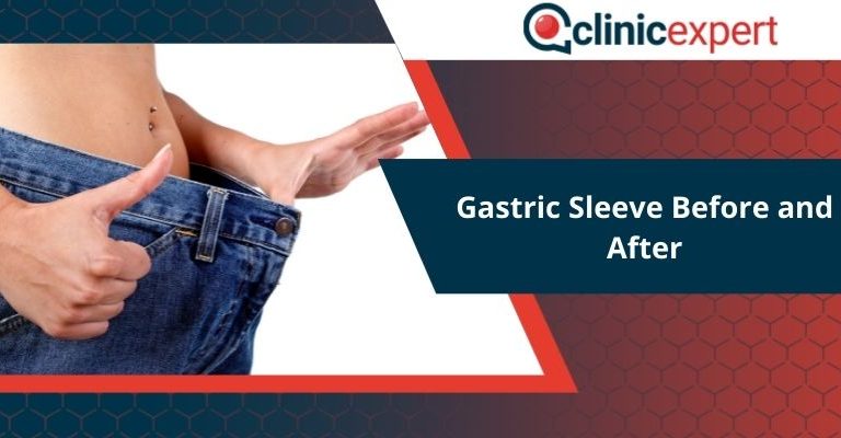 Gastric Sleeve Before and After