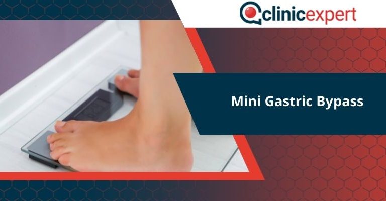 Mini Gastric Bypass