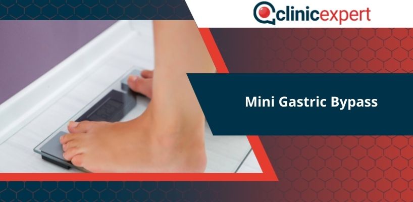 Mini Gastric Bypass