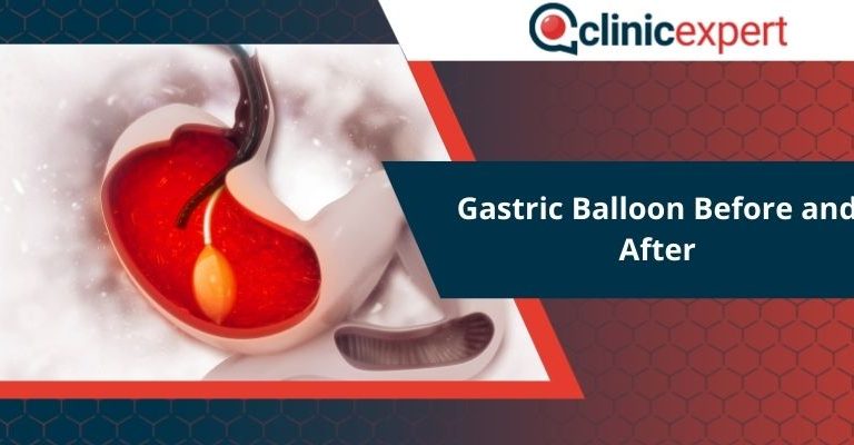 Gastric Balloon Before and After