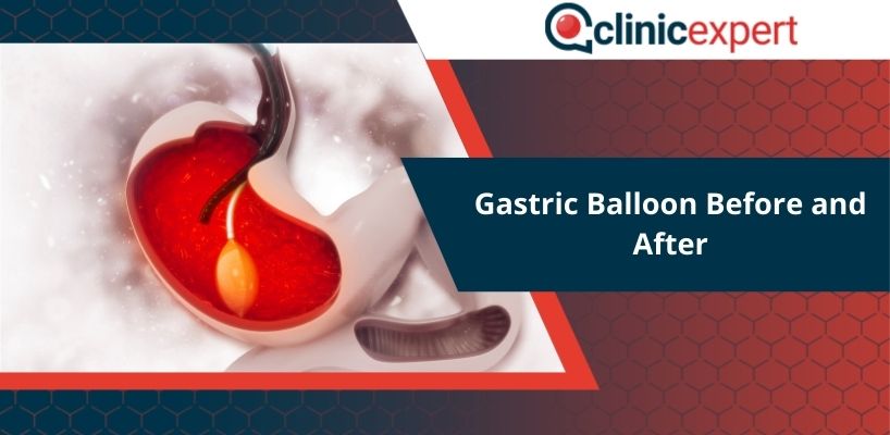 Gastric Balloon Before and After