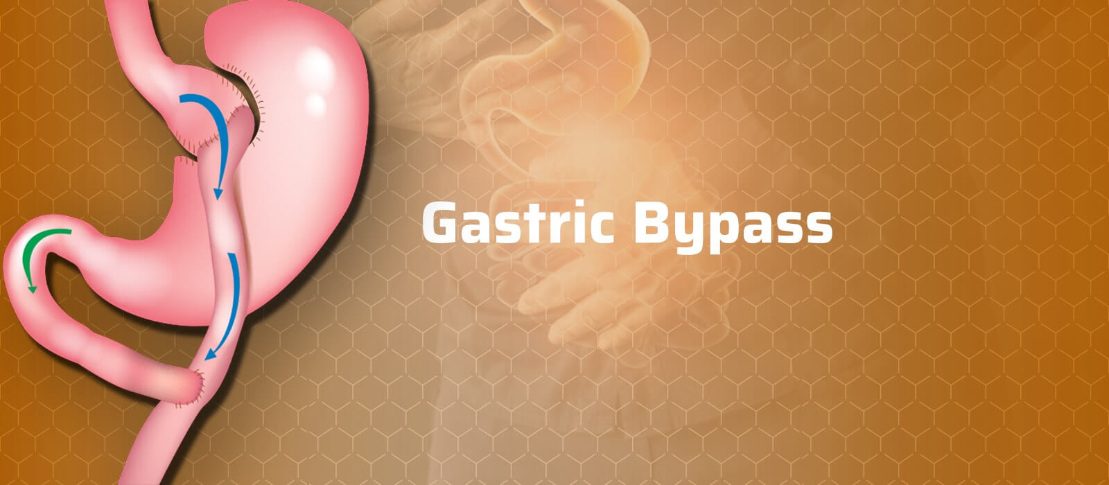 Gastric-Bypass