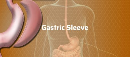 Gastric-Sleeve