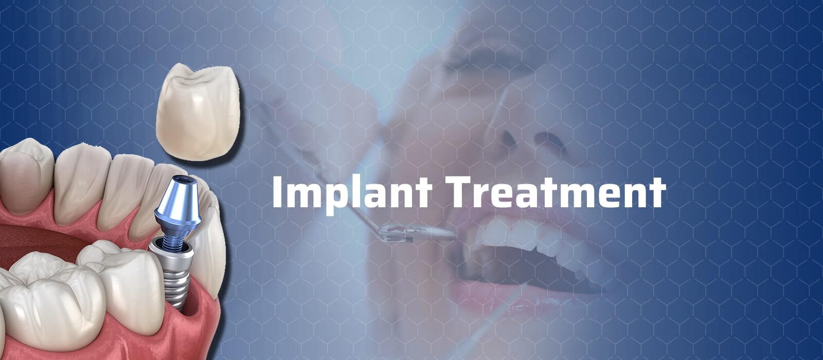 Implant-Treatment