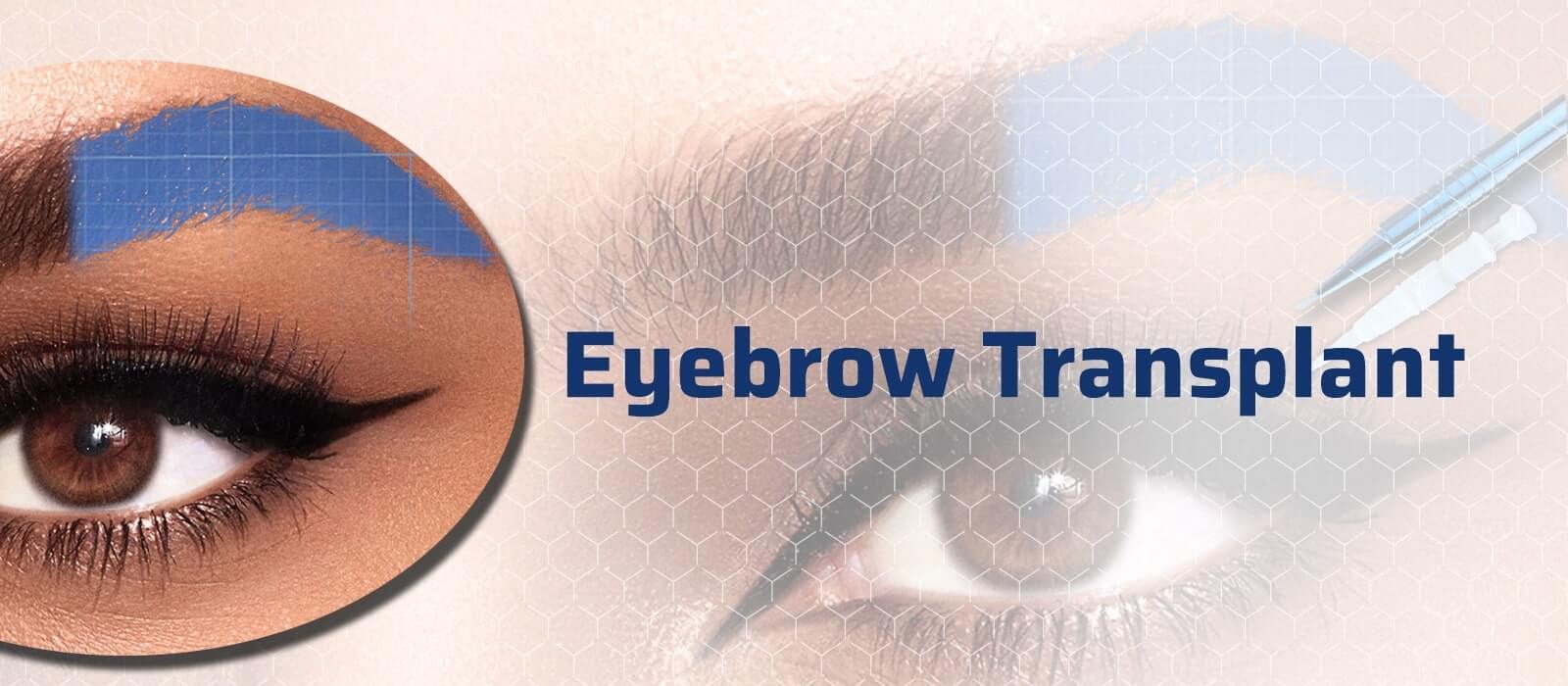 eyebrow transplant