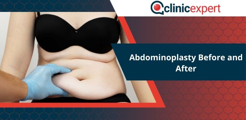 Abdominoplasty Before and After