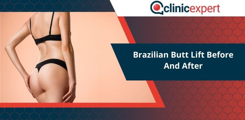 Brazilian Butt Lift Before And After