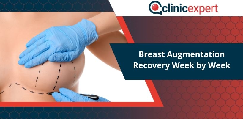Breast Augmentation Recovery Week by Week