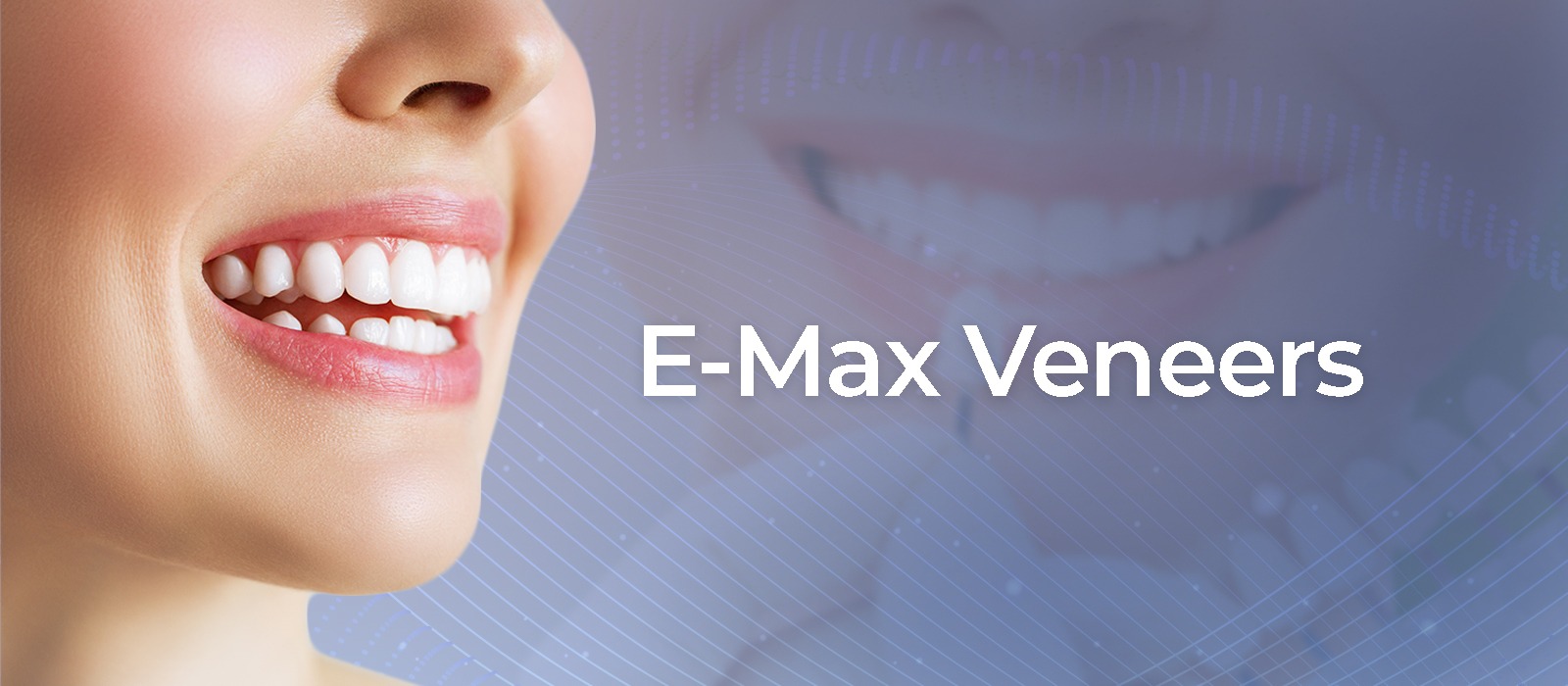 E-max Veneers