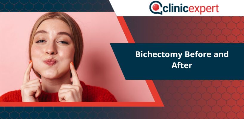Bichectomy