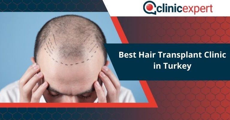 Best Hair Transplant Clinic in Turkey