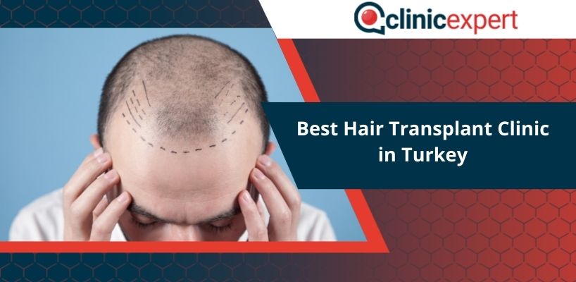 Best Hair Transplant Clinic in Turkey