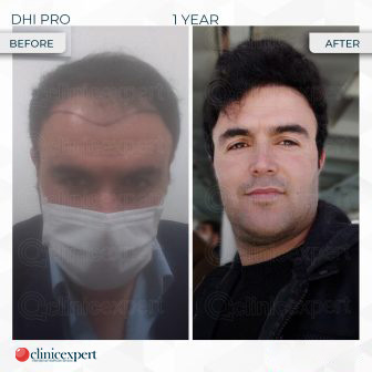 DHI Pro – Hair Transplant – one year