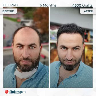 DHI Pro – Hair Transplant – 6 months - 4500 Grafts